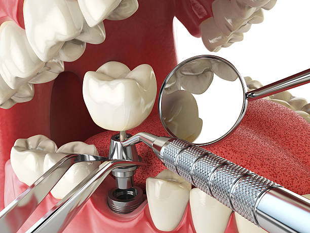 Best Emergency Dental Care for Sports Injuries in Greenlawn, NY